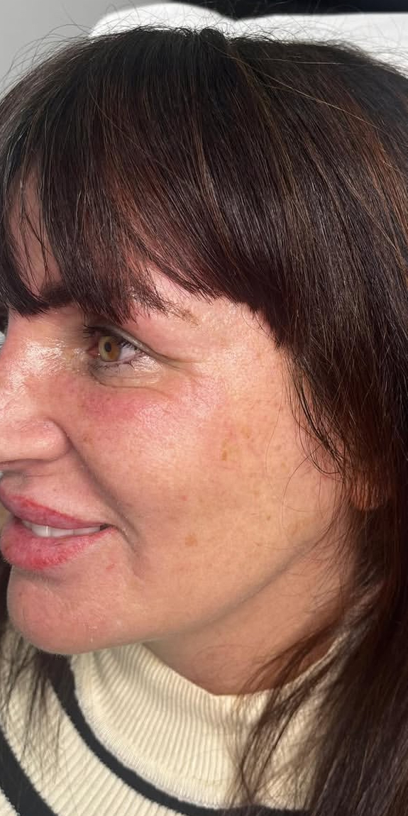 After anti-wrinkle injection treatment